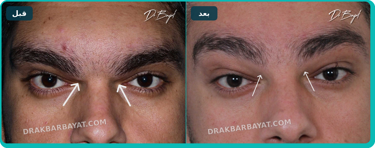 قبل و بعد اصلاح برجستگی بین ابروها (گلابلا) و پیشانی توسط دکتر اکبر بیات