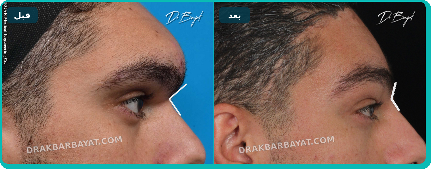 بهبود زاویه بینی و پیشانی پس از اصلاح برجستگی پیشانی قبل و بعد اصلاح برجستگی پیشانی و بهبود زاویه بینی و پیشانی توسط دکتر اکبر بیات