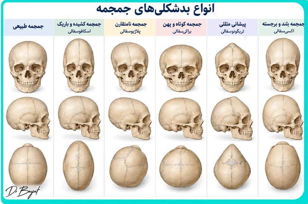 انواع بدشکلی‌های جمجمه شامل جمجمه طبیعی، اسکافوسفالی، پلاژیوسفالی، براکی‌سفالی، تریگونوسفالی و اکسی‌سفالی در نماهای مختلف