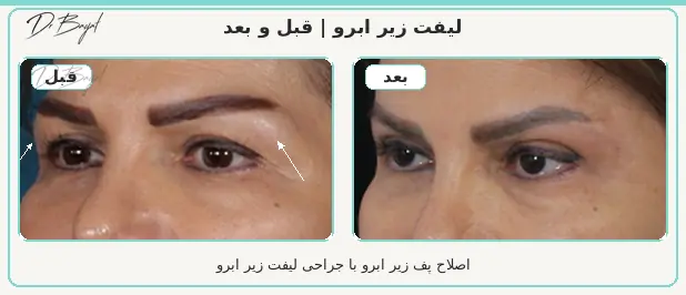مقایسه نمای نزدیک چشم و ابرو قبل و بعد از جراحی لیفت زیر ابرو