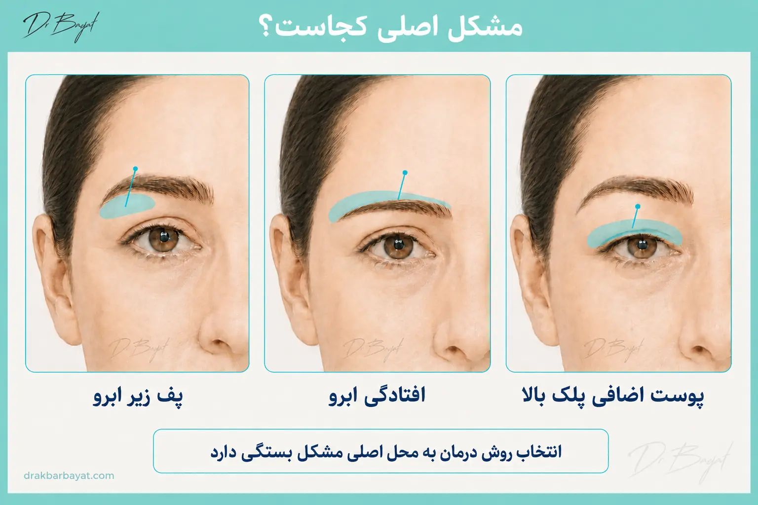 شماتیک مقایسه محل پف زیر ابرو، افتادگی ابرو و پوست اضافی پلک بالا