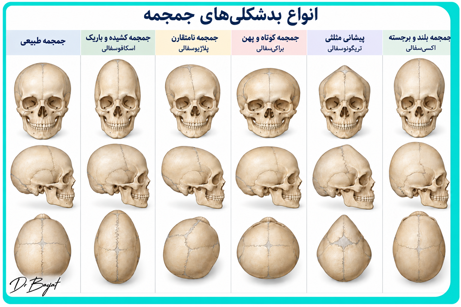 انواع بدشکلی‌های جمجمه شامل پیشانی مثلثی، جمجمه کشیده، نامتقارن، کوتاه و پهن و بلند و برجسته