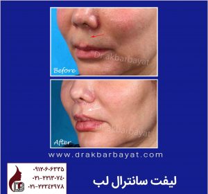 جراحی زیبایی لب | iran lip surgery | جراحی زیبایی لب