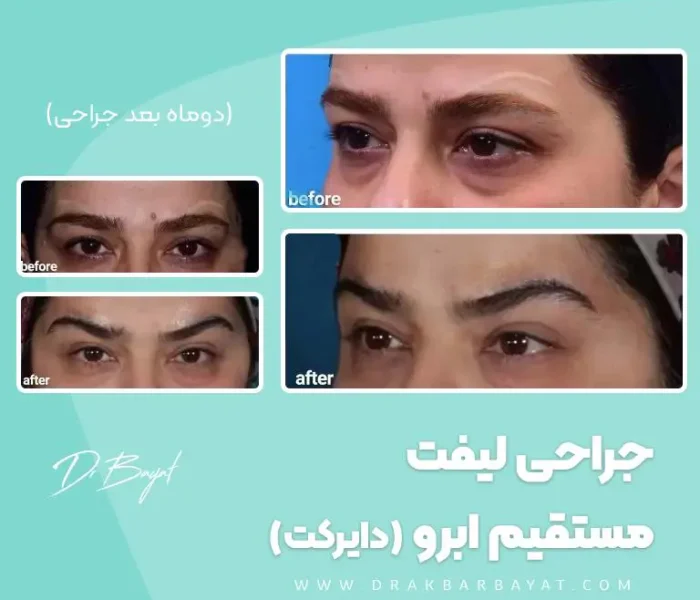 جراحی لیفت دایرکت ابرو برای برداشتن اسکار تتو قبلی