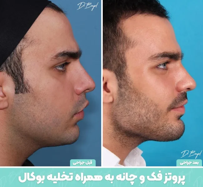 جراحی لیفت گردن