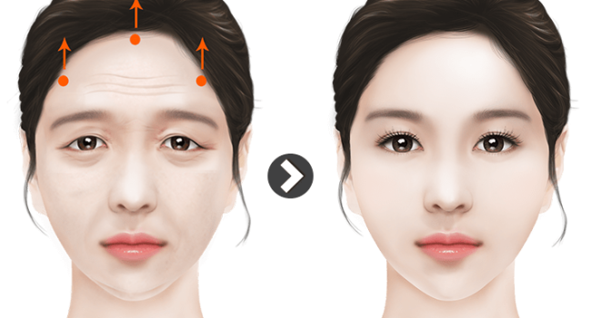 لیفت-پیشانی