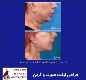 لیفت صورت |‌ لیفت صورت و گردن | جراحی لیفت صورت| بهترین جراح لیفت ایران