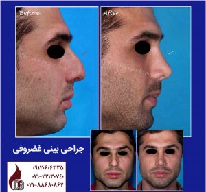 جراحی بینی غضروفی |دکتر اکبر بیات