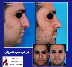 جراحی بینی غضروفی|دکتر اکبر بیات