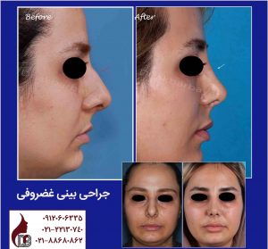 جراحی بینی غضروفی|دکتر اکبر بیات