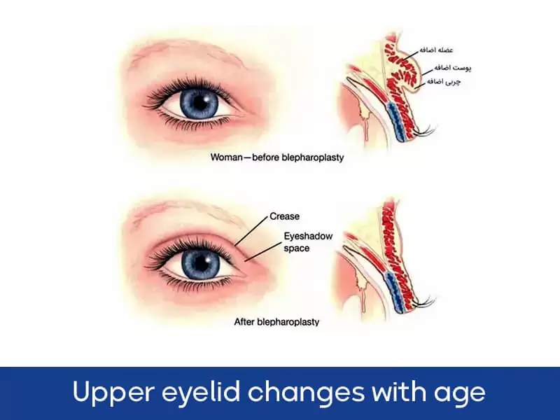 Upper eyelid changes with age